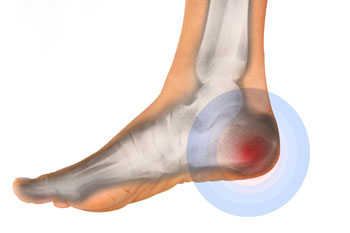 heel pain